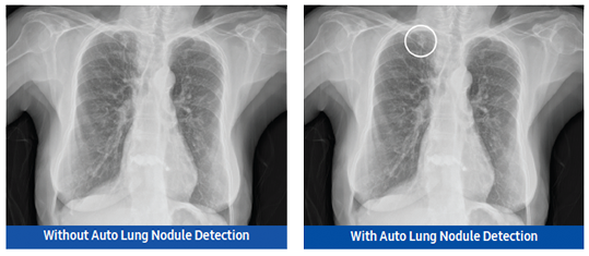 Image with Auto Lunch Nodule Detection