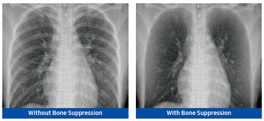 Image with Bone Suppression