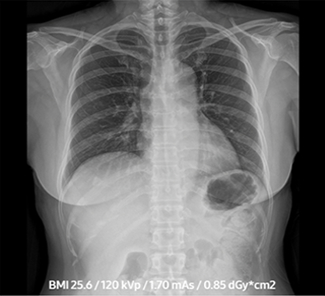 Adult Chest PA Image Conventional