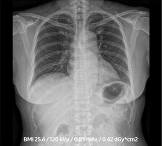 Adult Chest PA Image Low Dose