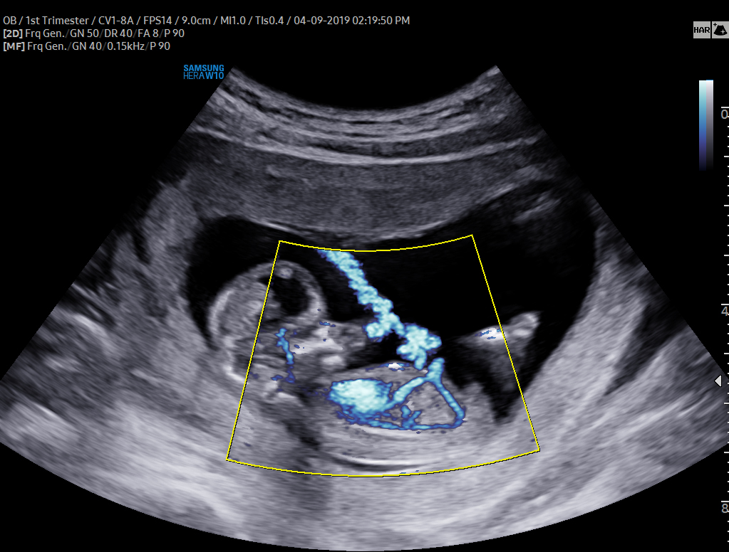 12 Wk Circulation MV-Flow