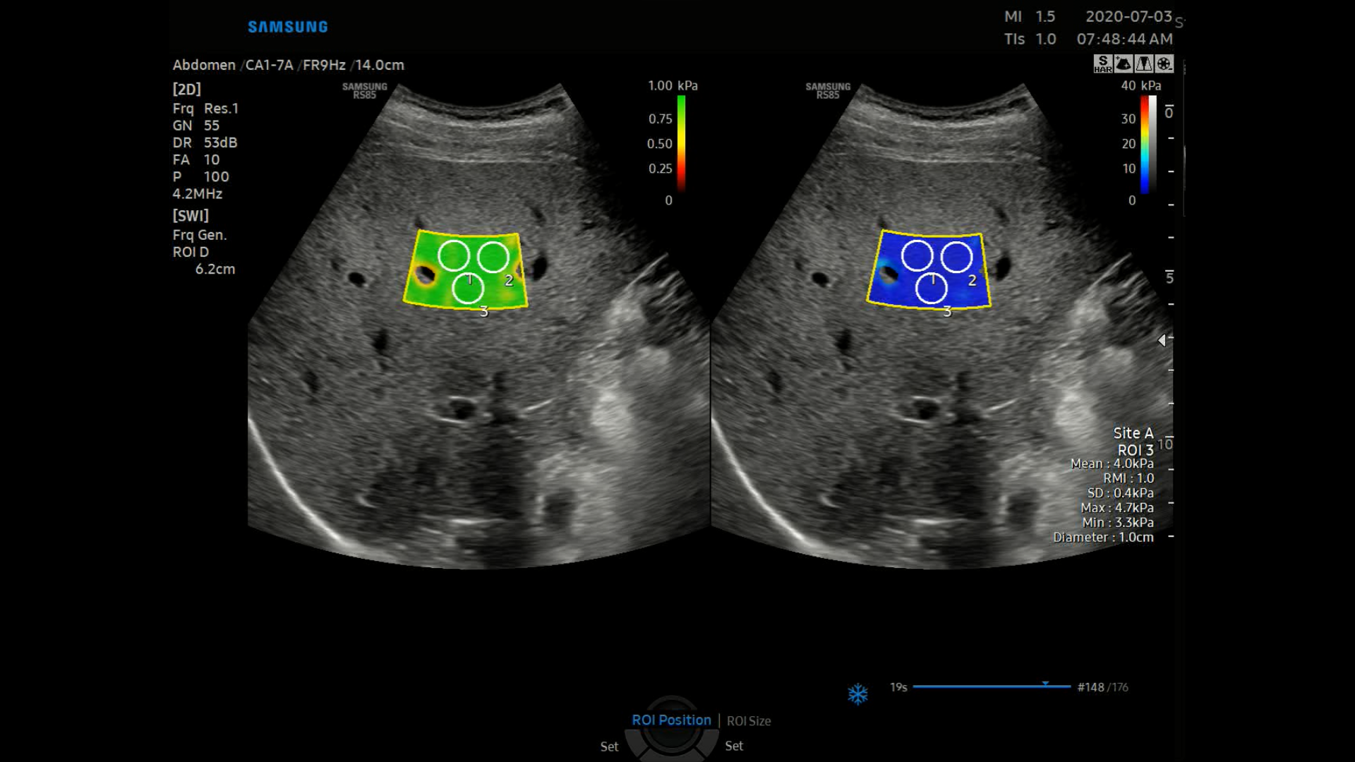 S-Shearwave Normal Liver