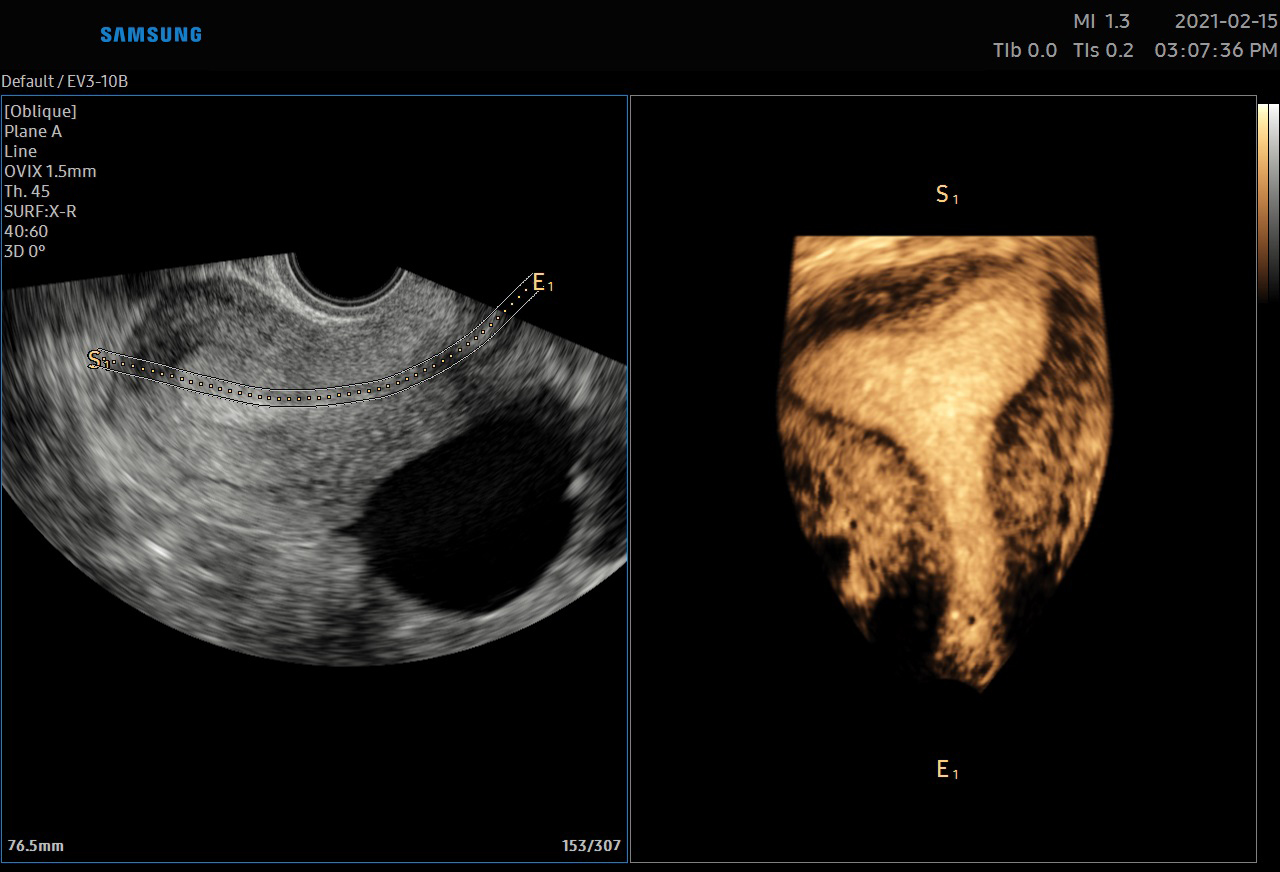 UTERINCONTOUR