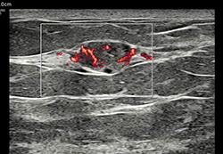 breast-with-MV-Flow