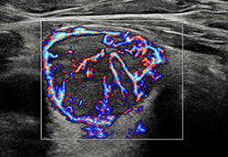 thyroid