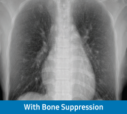 San with Bone Suppression