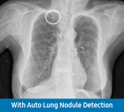 Scan with Lung Nodule Detection