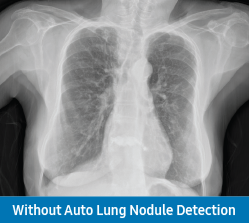 Scan without Auto Lung Nodule Detection