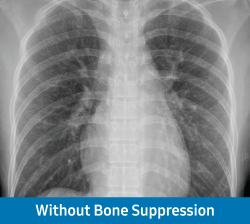 Scan without Bone Suppression